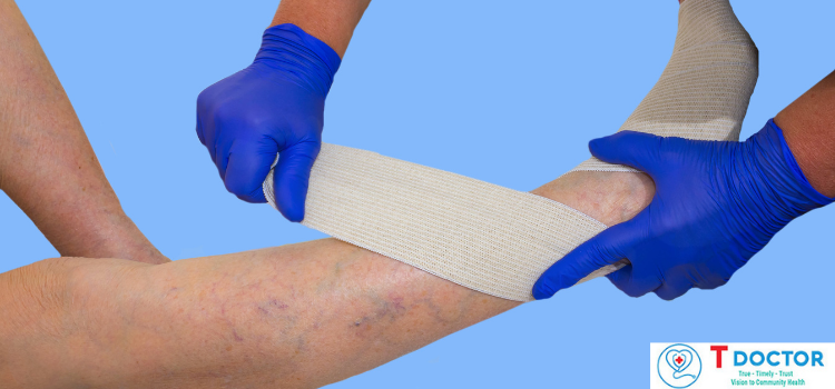 Dấu hiệu suy giãn tĩnh mạch chân là gì, cách điều trị